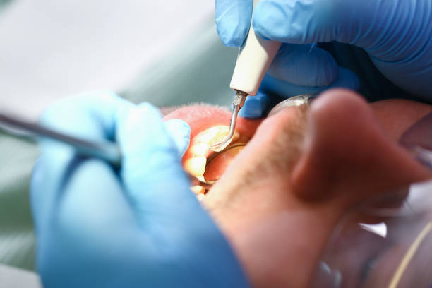 Best Emergency Dentist for Lost Fillings or Crowns in North Utica, IL